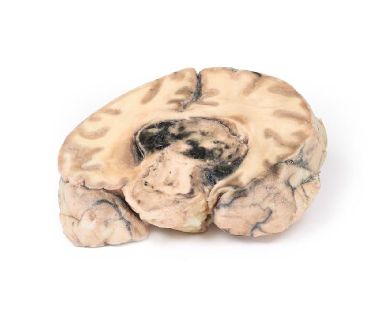 3D Printed Glioblastoma Multiforme in Inferior Frontal Lobe