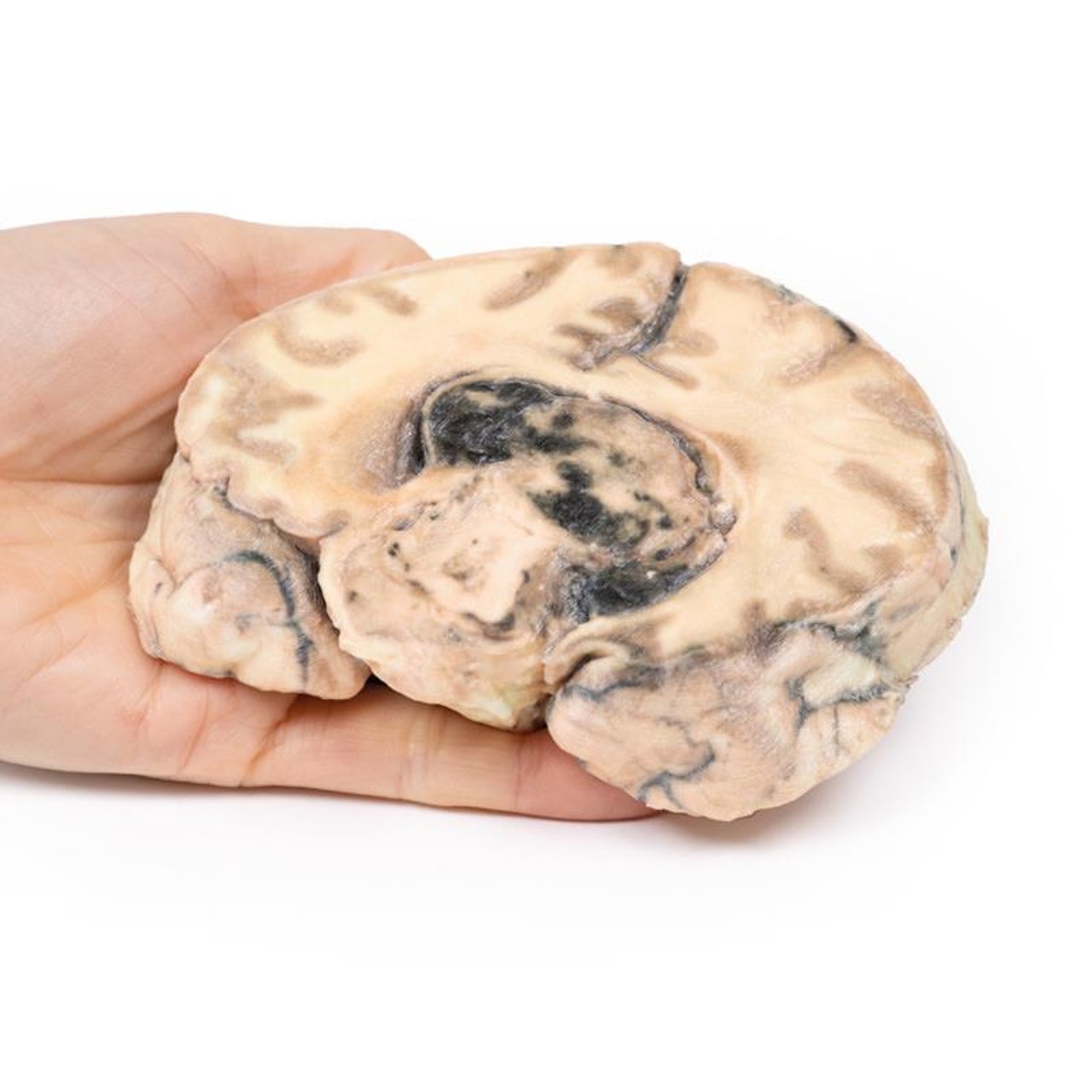 3D Printed Glioblastoma Multiforme in Inferior Frontal Lobe