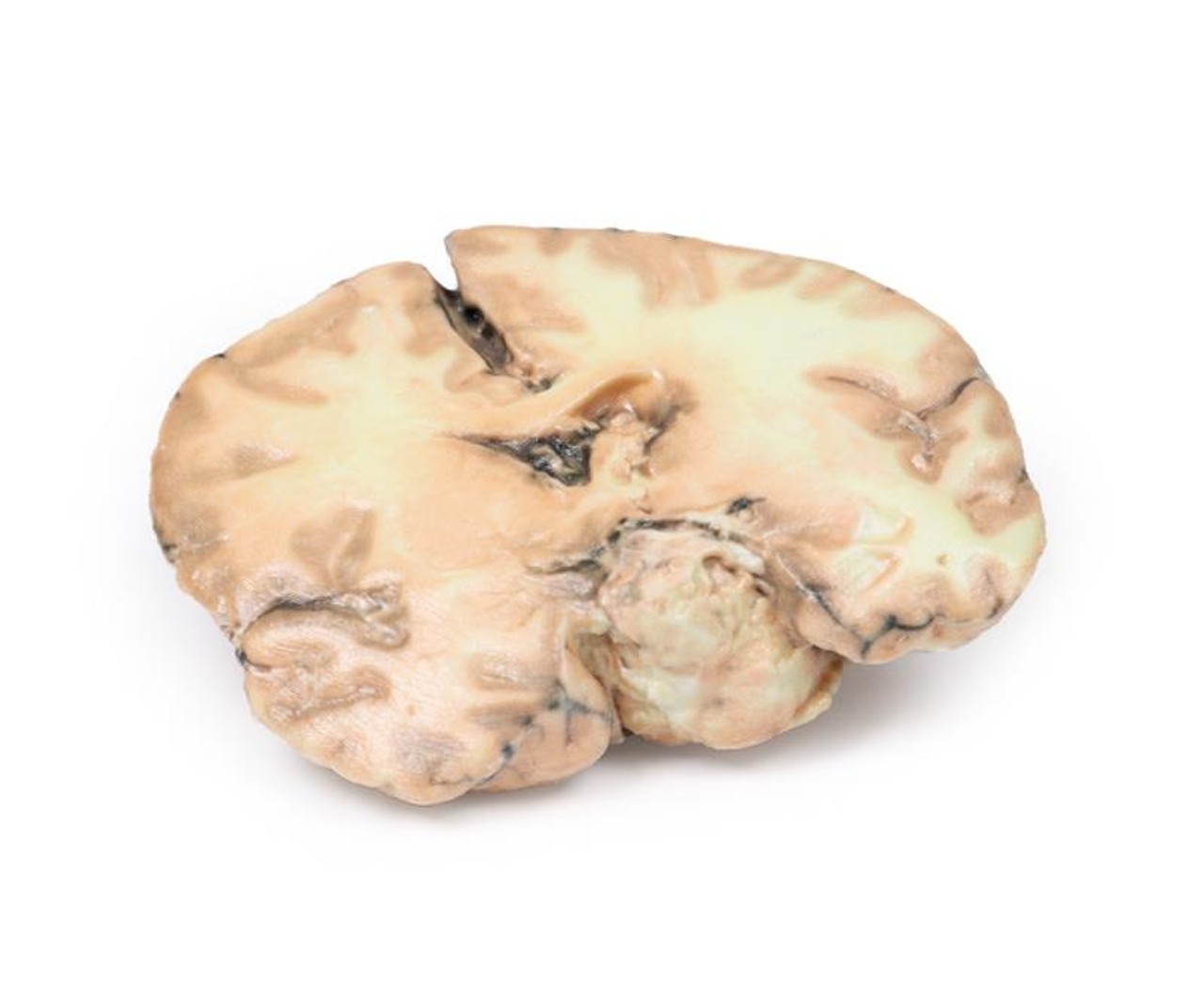 3D Printed Glioblastoma Multiforme in Inferior Frontal Lobe