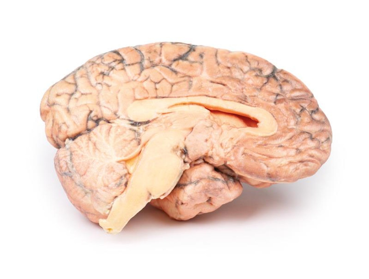 3D Printed Craniopharyngioma