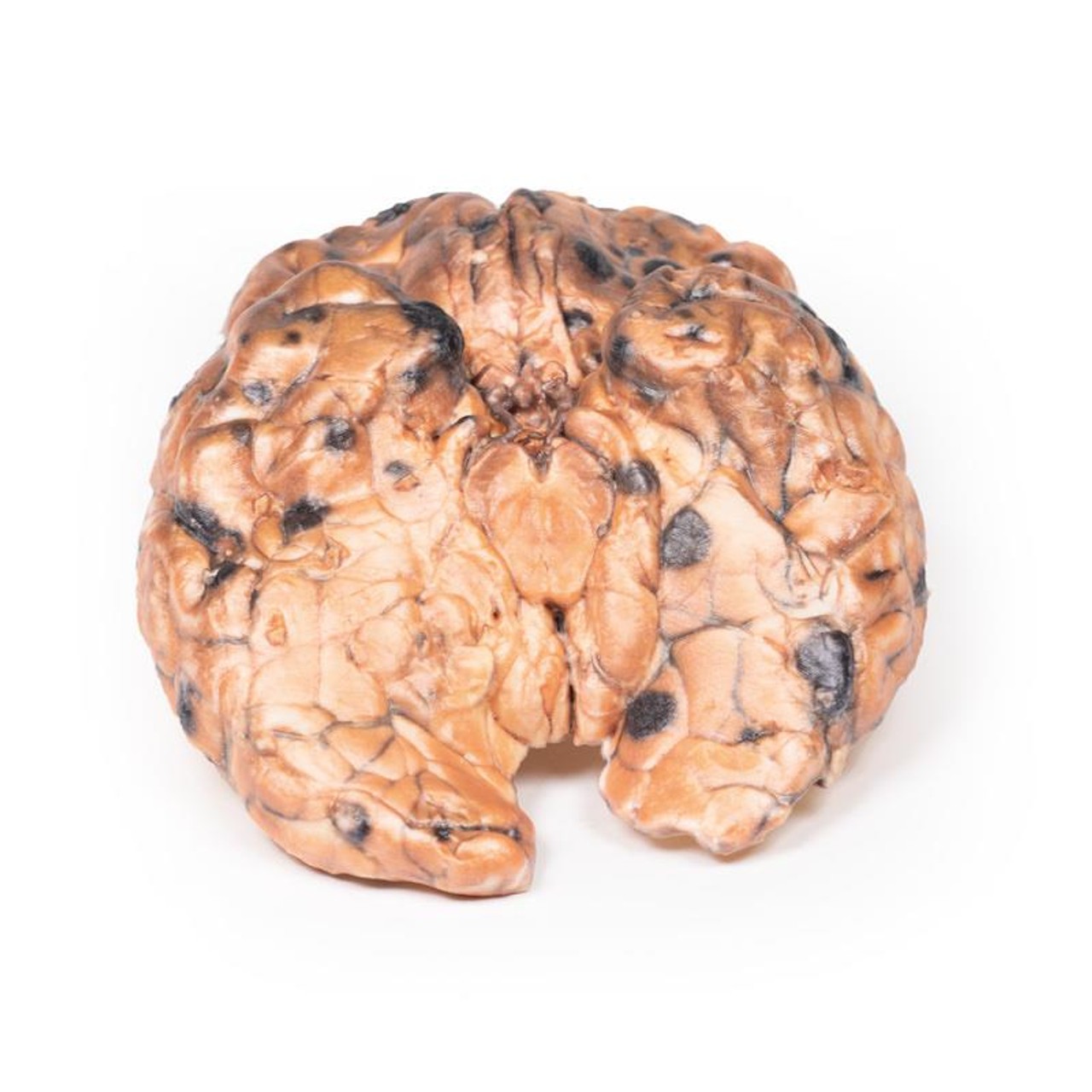 3D Printed Metastatic Melanoma