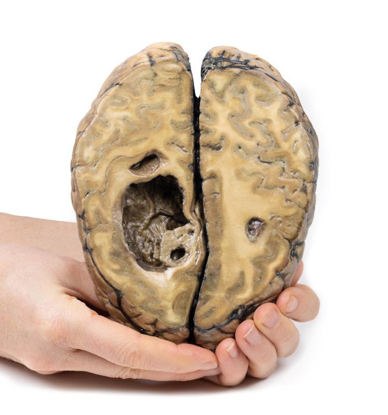 3D Printed Metastatic Carcinoma in the Brain