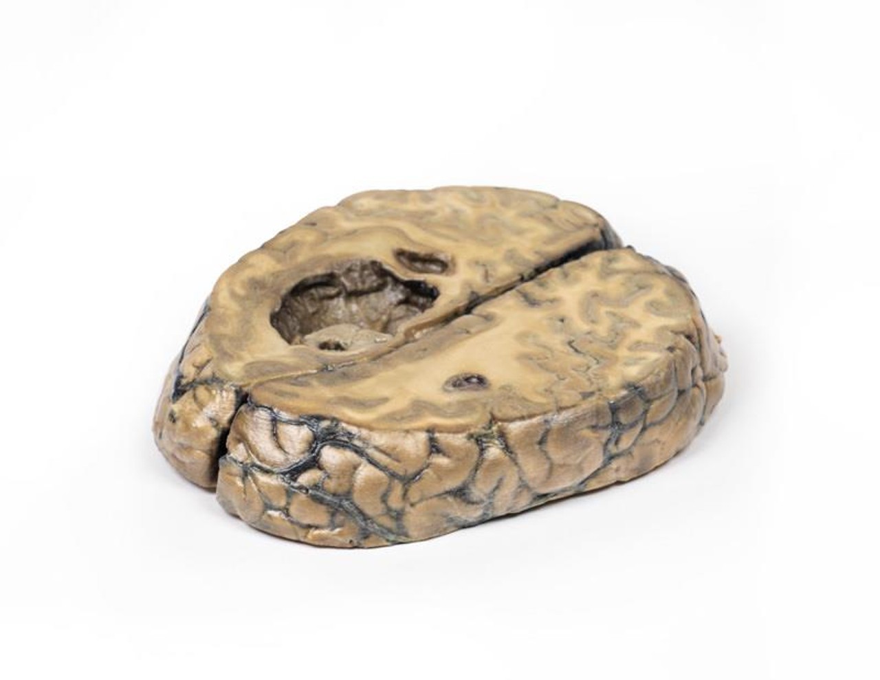 3D Printed Metastatic Carcinoma in the Brain