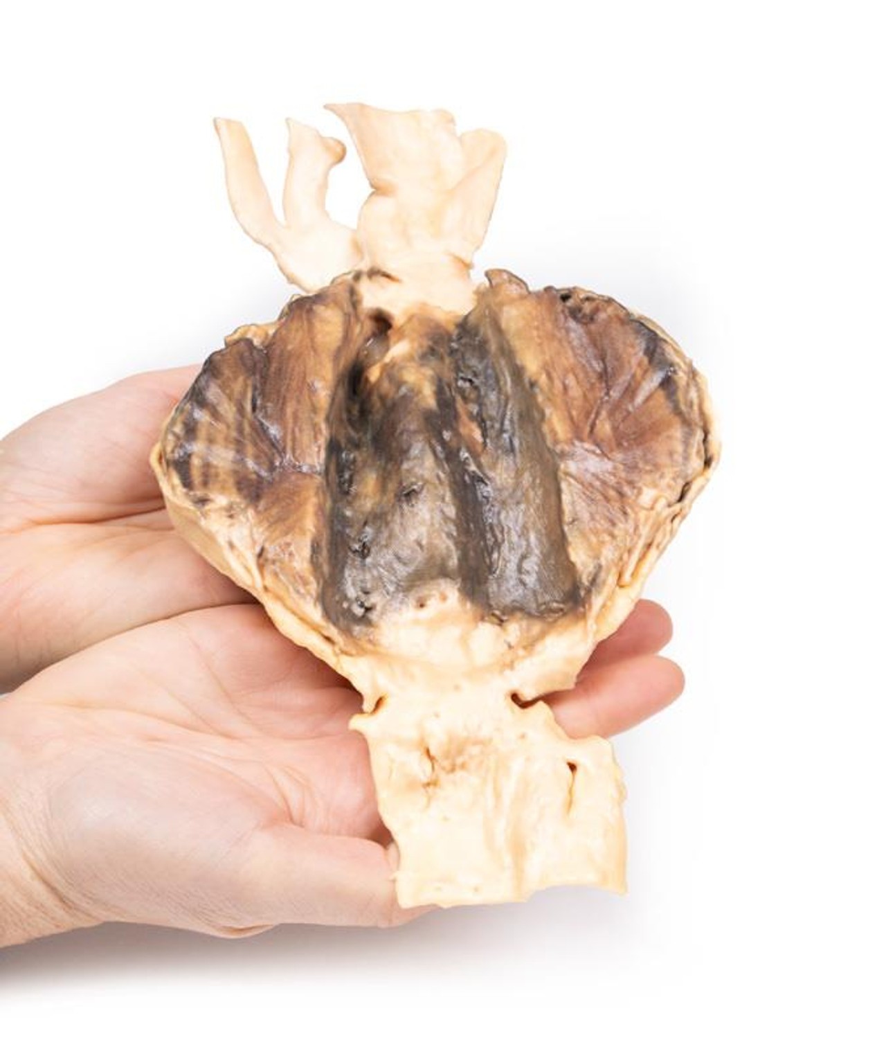 3D Printed Abdominal Aortic Aneurysm