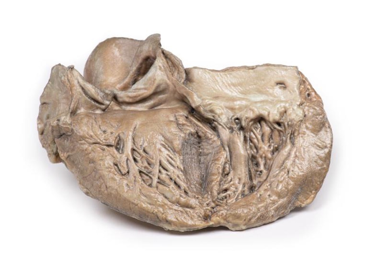 3D Printed Bicuspid Aortic Valve