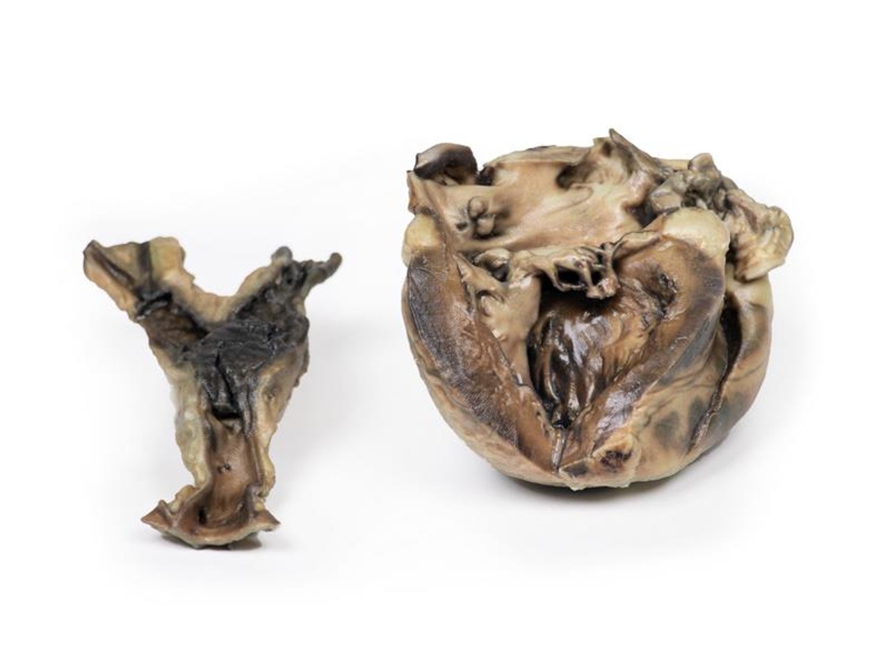 3D Printed Hydatid Disease Affecting the Heart and Aorta