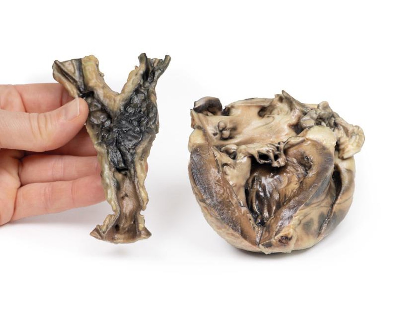 3D Printed Hydatid Disease Affecting the Heart and Aorta