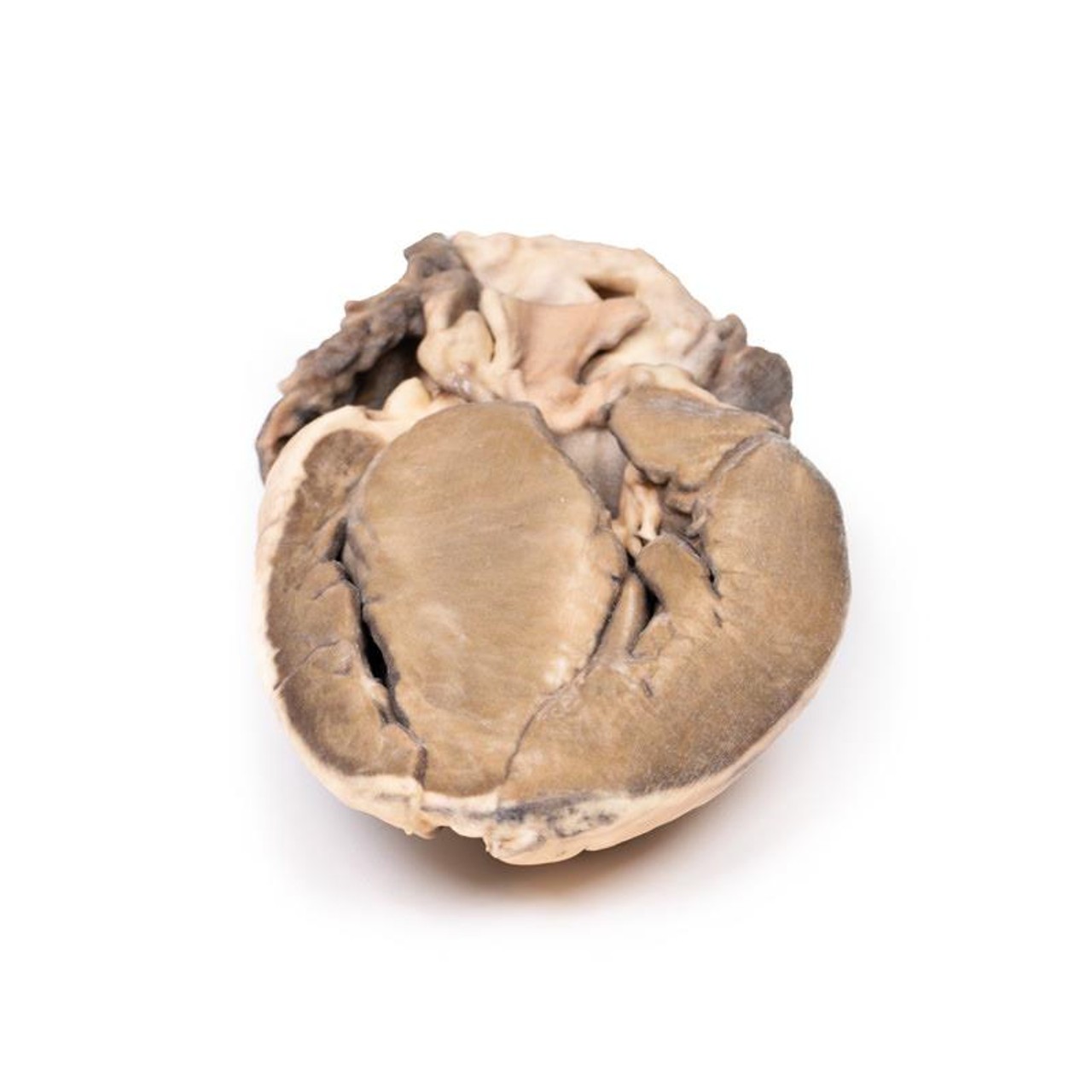 3D Printed Hypertrophic Subaortic Stenosis