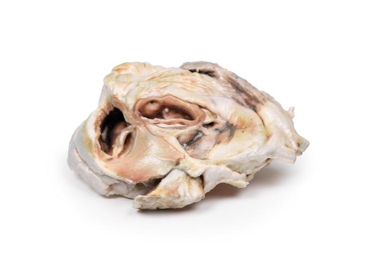 3D Printed Calcified Aortic Valvular Stenosis Bicuspid Aortic Valve
