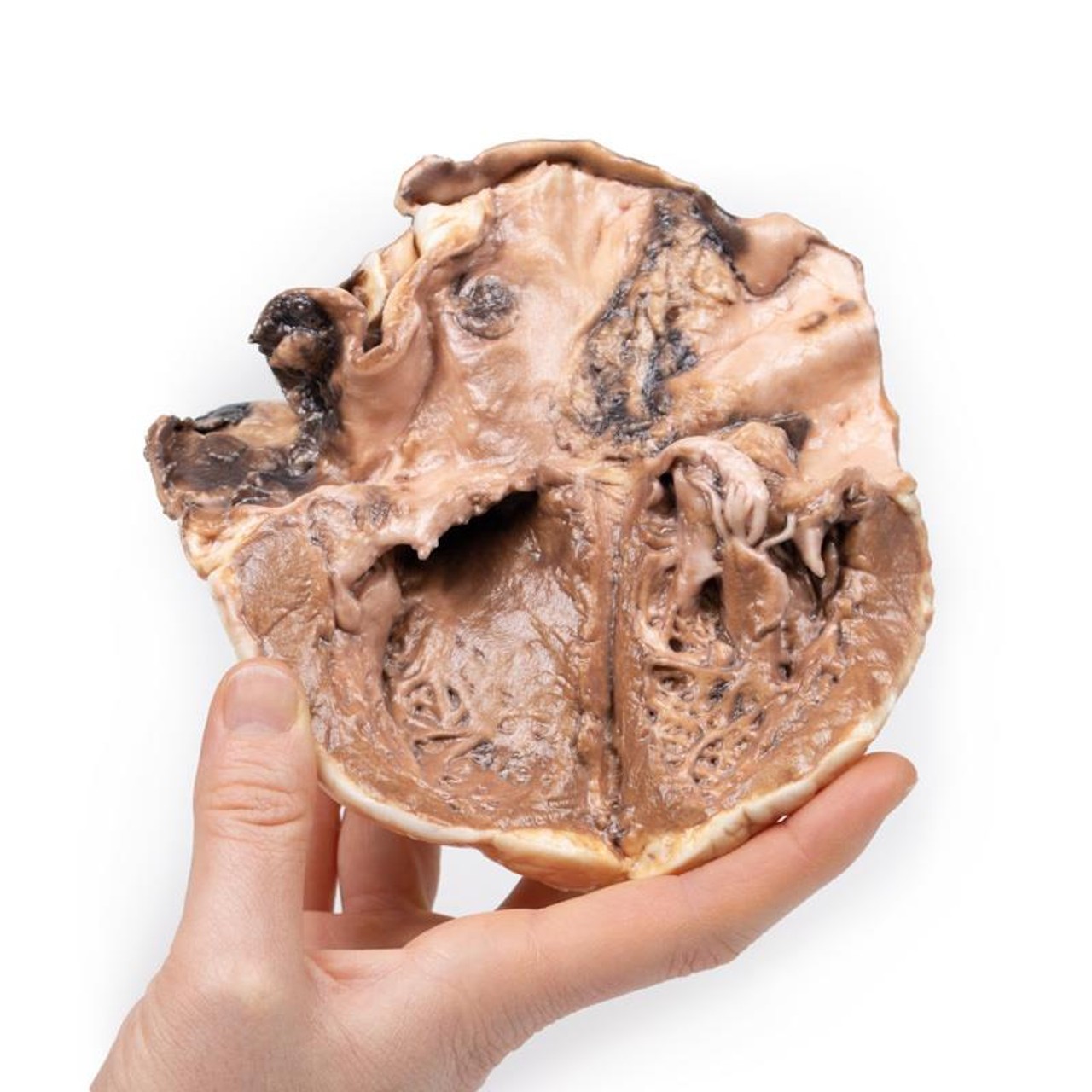 3D Printed Rheumatic Endocarditis