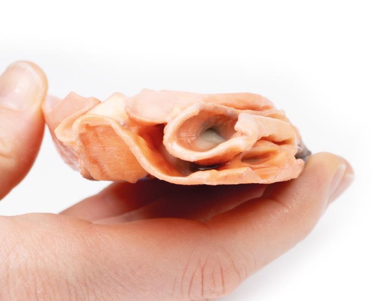 3D Printed Traumatic Oesophageal-Aortic Fistula
