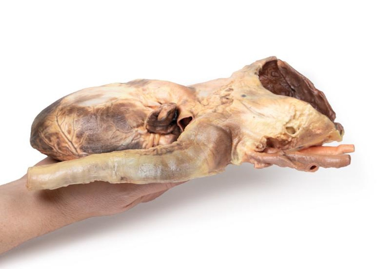 3D Printed Syphilitic Aneurysm