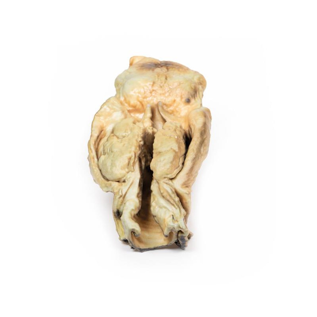 3D Printed Carcinoma of Larynx