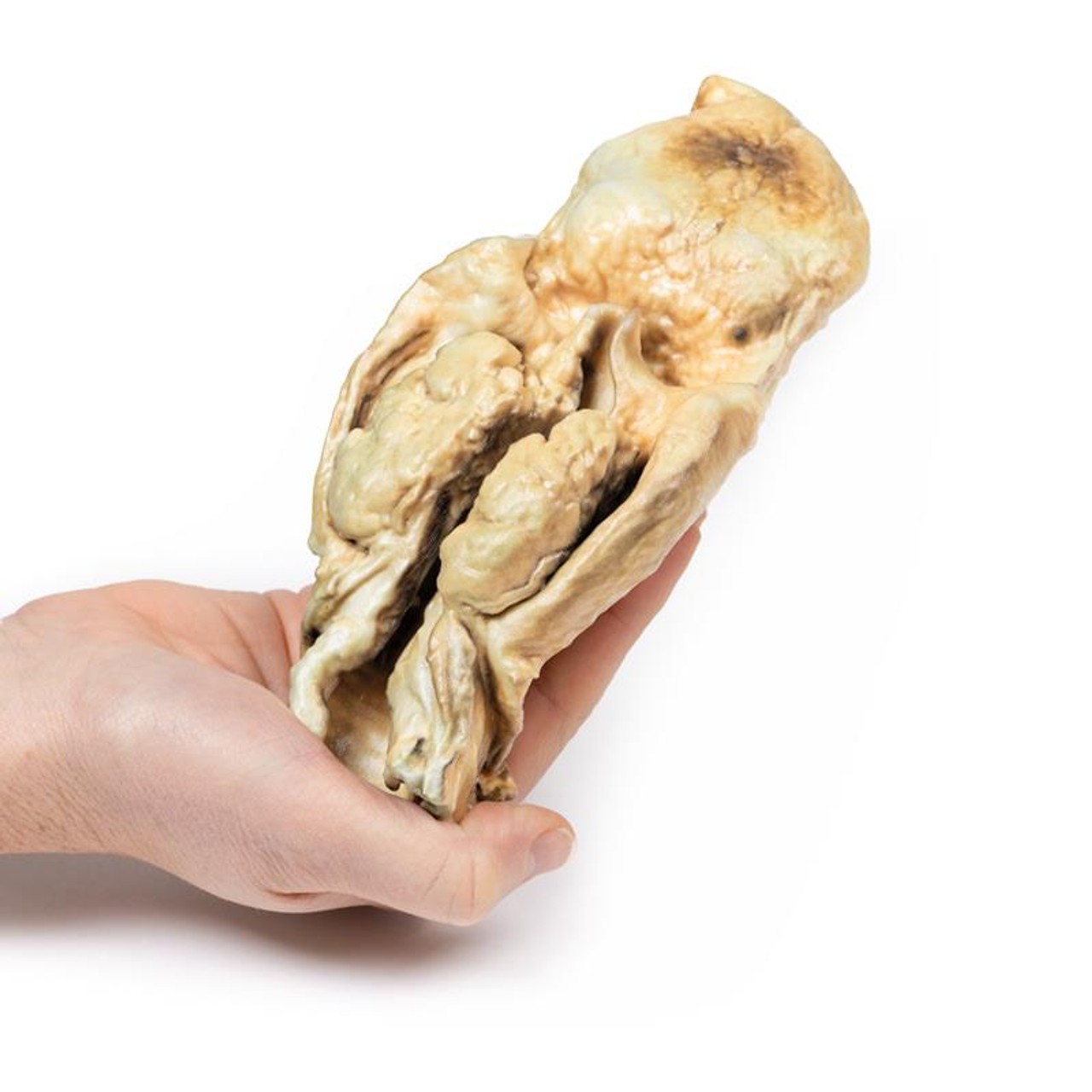3D Printed Carcinoma of Larynx