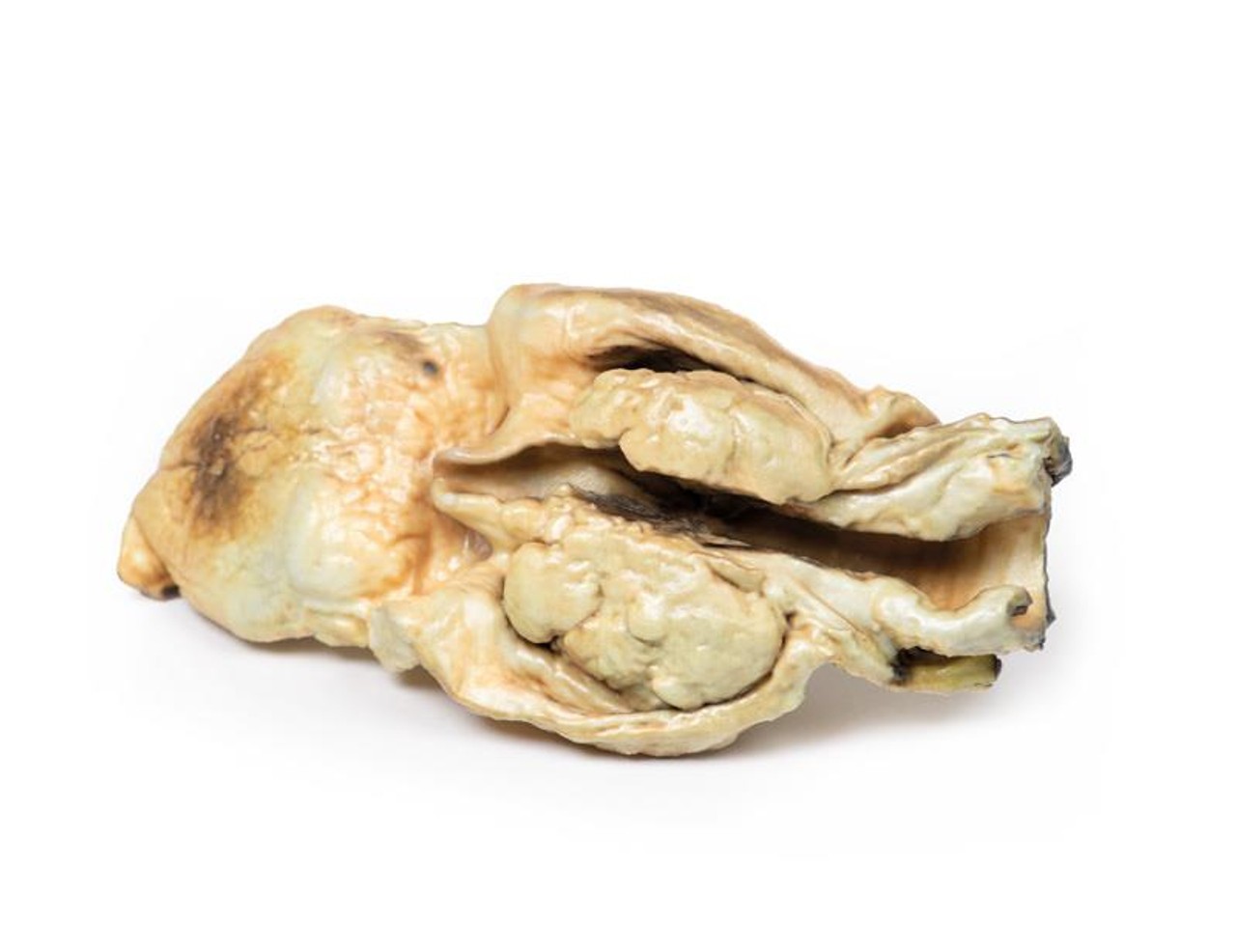 3D Printed Carcinoma of Larynx