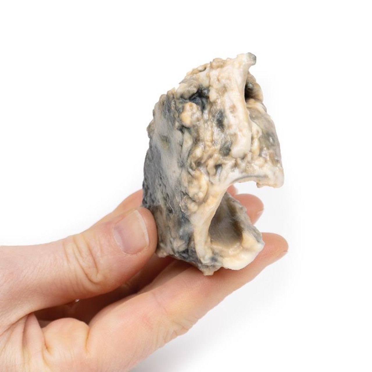 3D Printed Carcinoma of Larynx