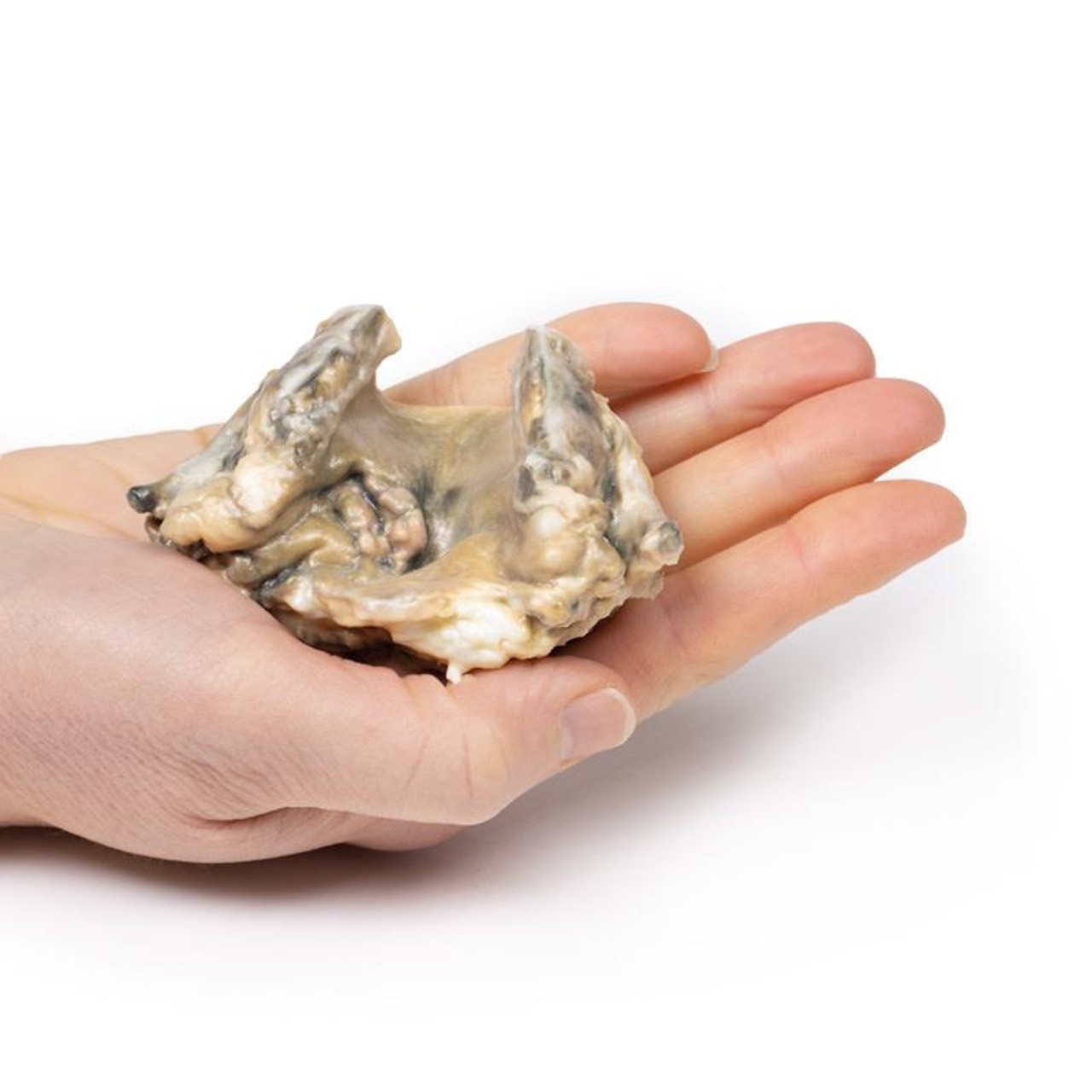 3D Printed Carcinoma of Larynx