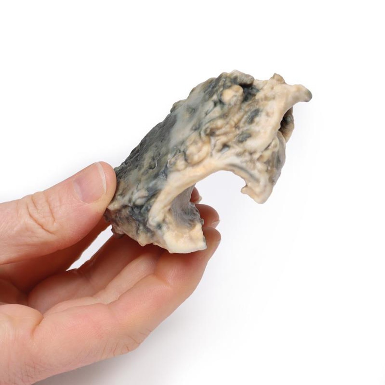 3D Printed Carcinoma of Larynx