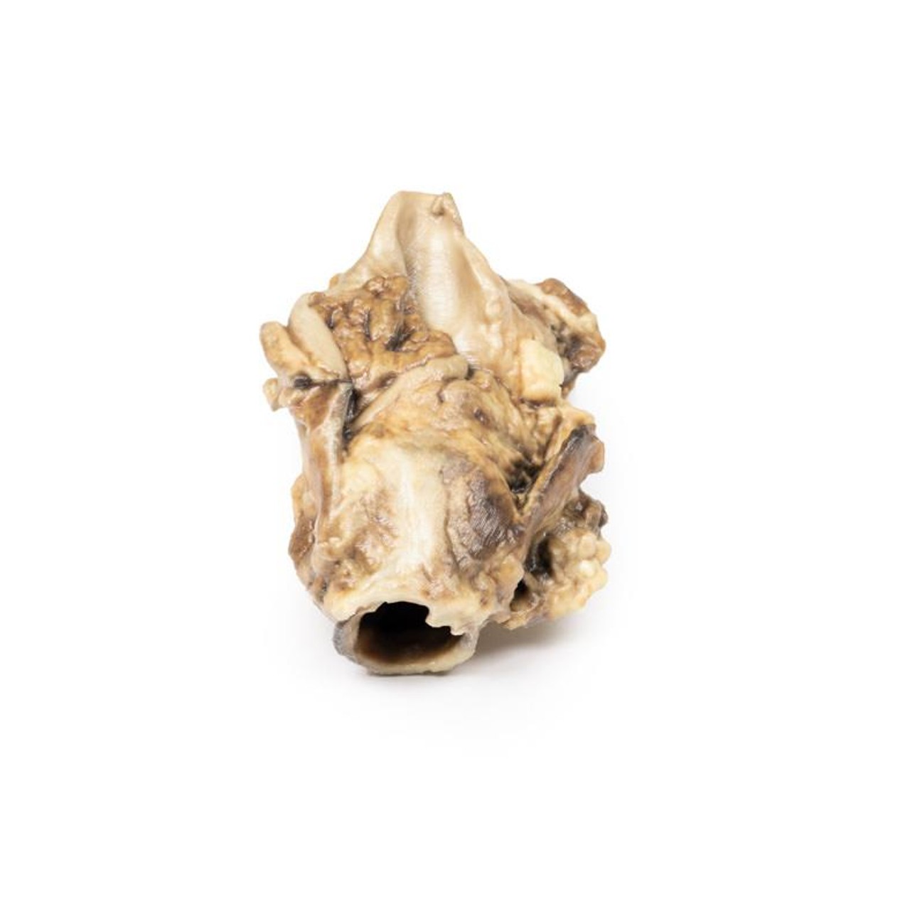 3D Printed Carcinoma of Pyriform Fossa