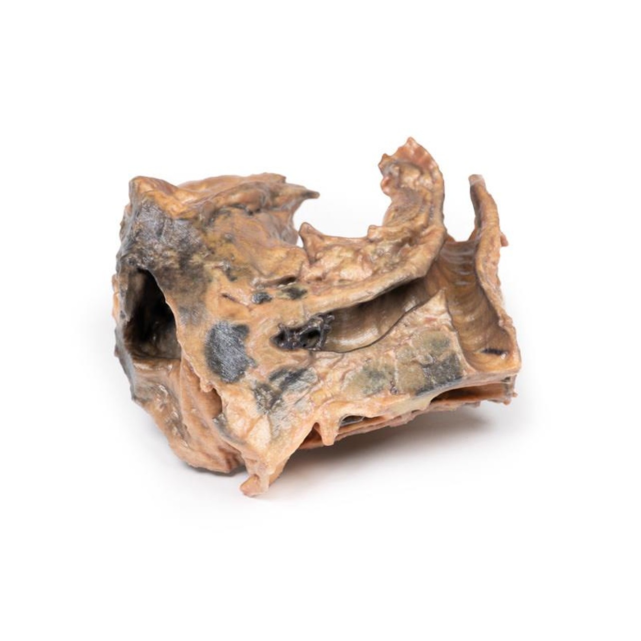 3D Printed Inhaled Foreign Body in the Trachea