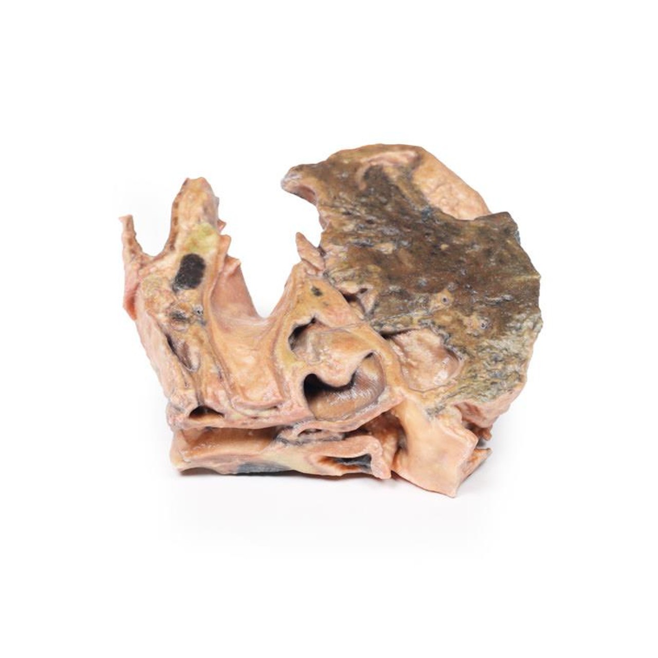 3D Printed Inhaled Foreign Body in the Trachea