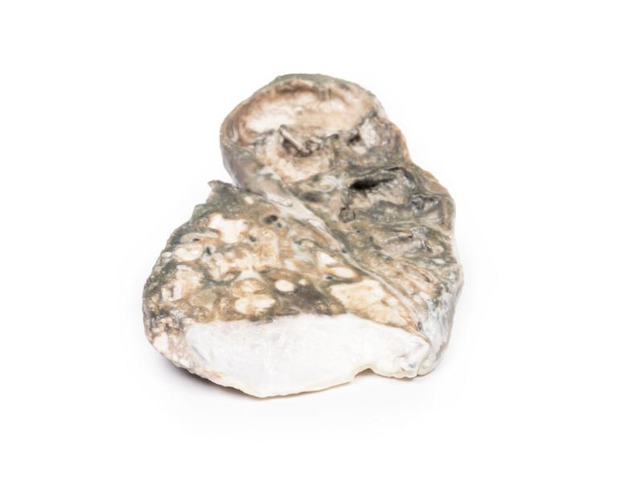 3D Printed Fibrocaseous Tuberculosis
