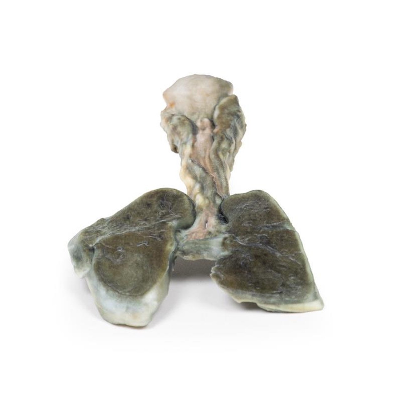 3D Printed Tracheoesophageal Fistula and Oesophagus Atresia