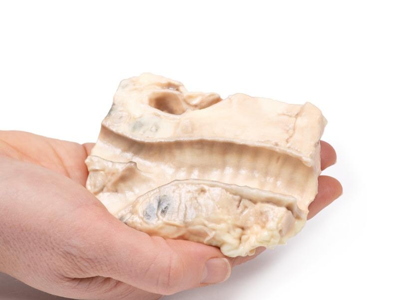 3D Printed Hodgkin Lymphoma in the Trachea