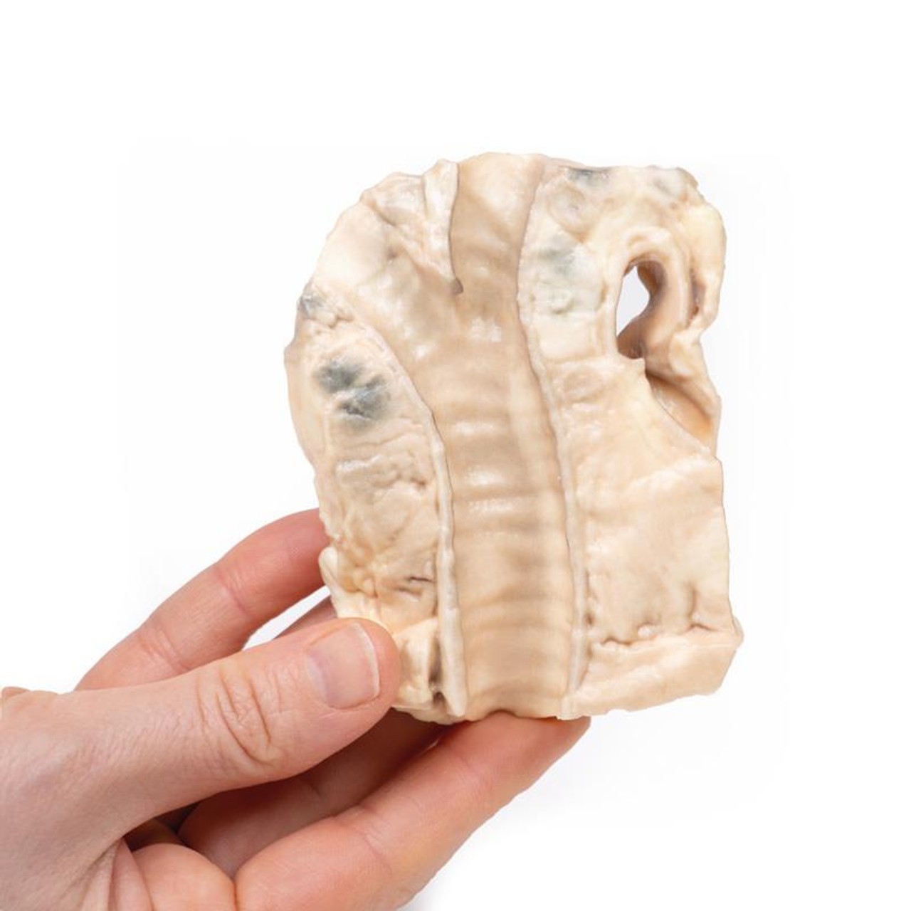 3D Printed Hodgkin Lymphoma in the Trachea