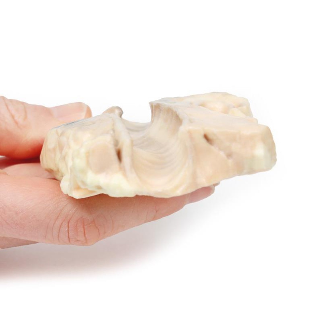 3D Printed Hodgkin Lymphoma in the Trachea