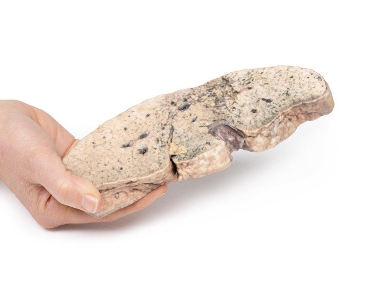 3D Printed Liver Cirrhosis