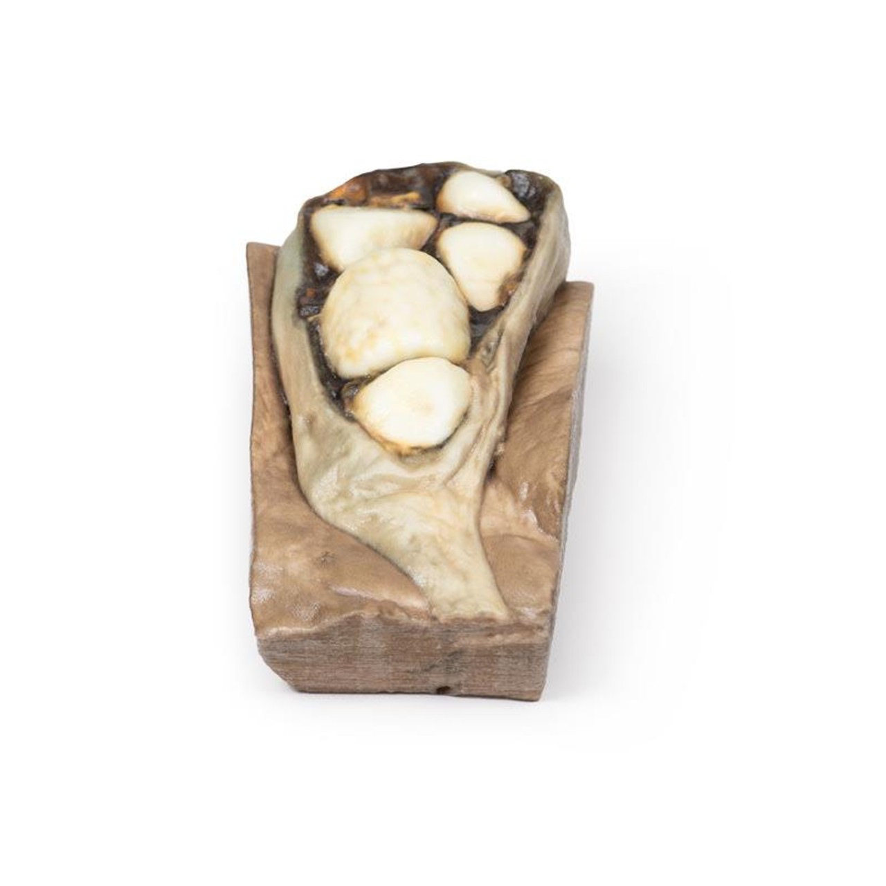 3D Printed Cholelithiasis (Gallstones)
