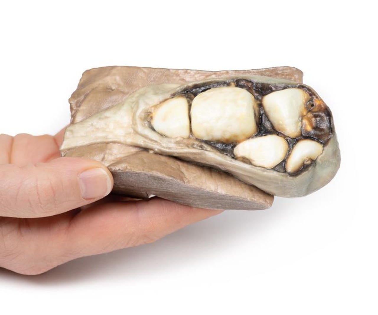 3D Printed Cholelithiasis (Gallstones)