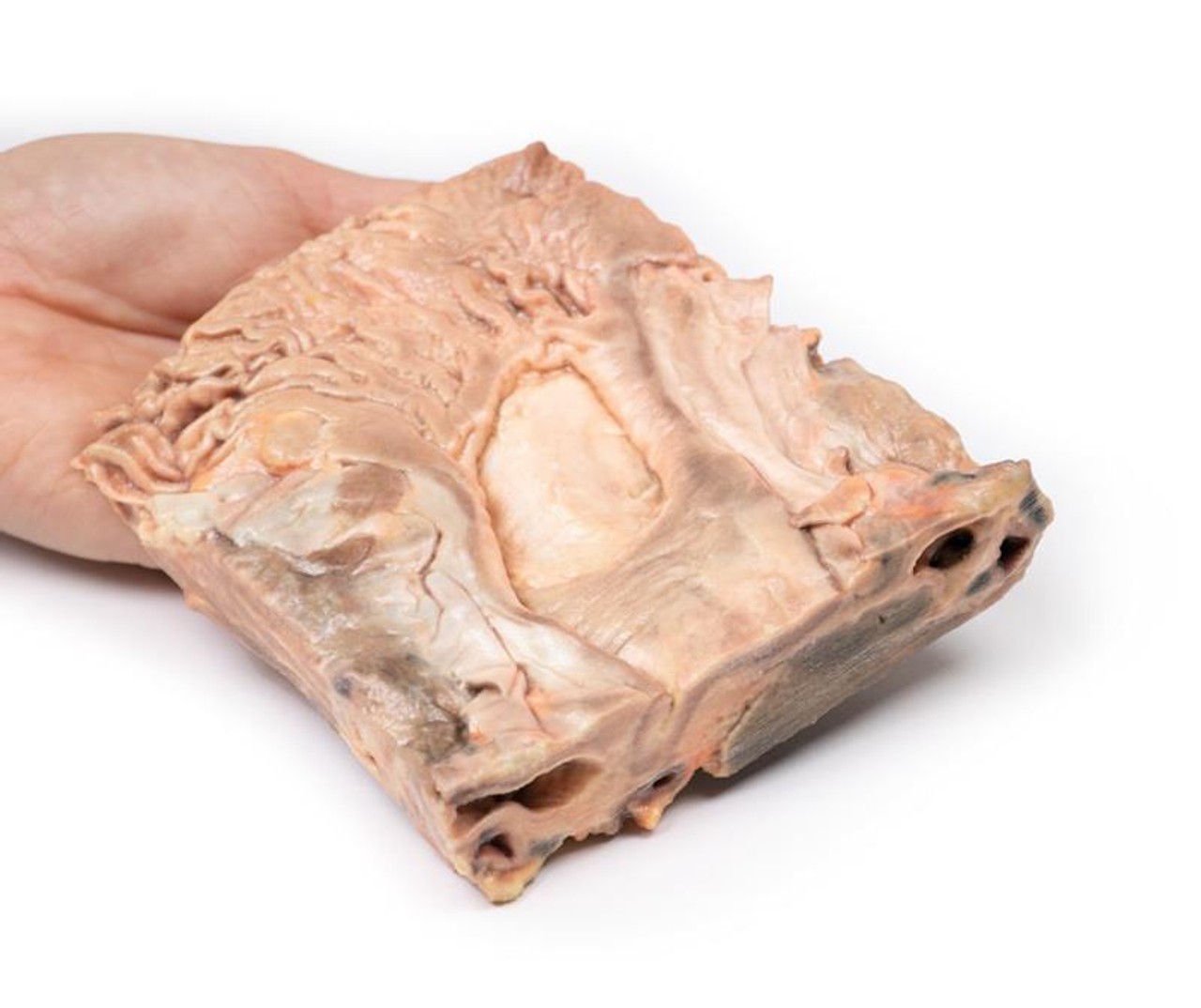 3D Printed Chronic Gastric Ulcer