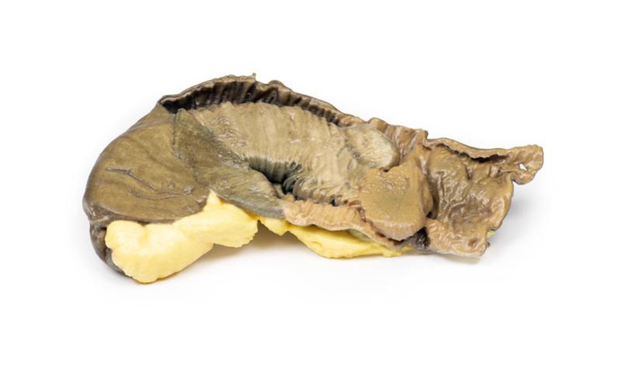 3D Printed Intussusception of Small Bowel Due to Metastatic Tumour