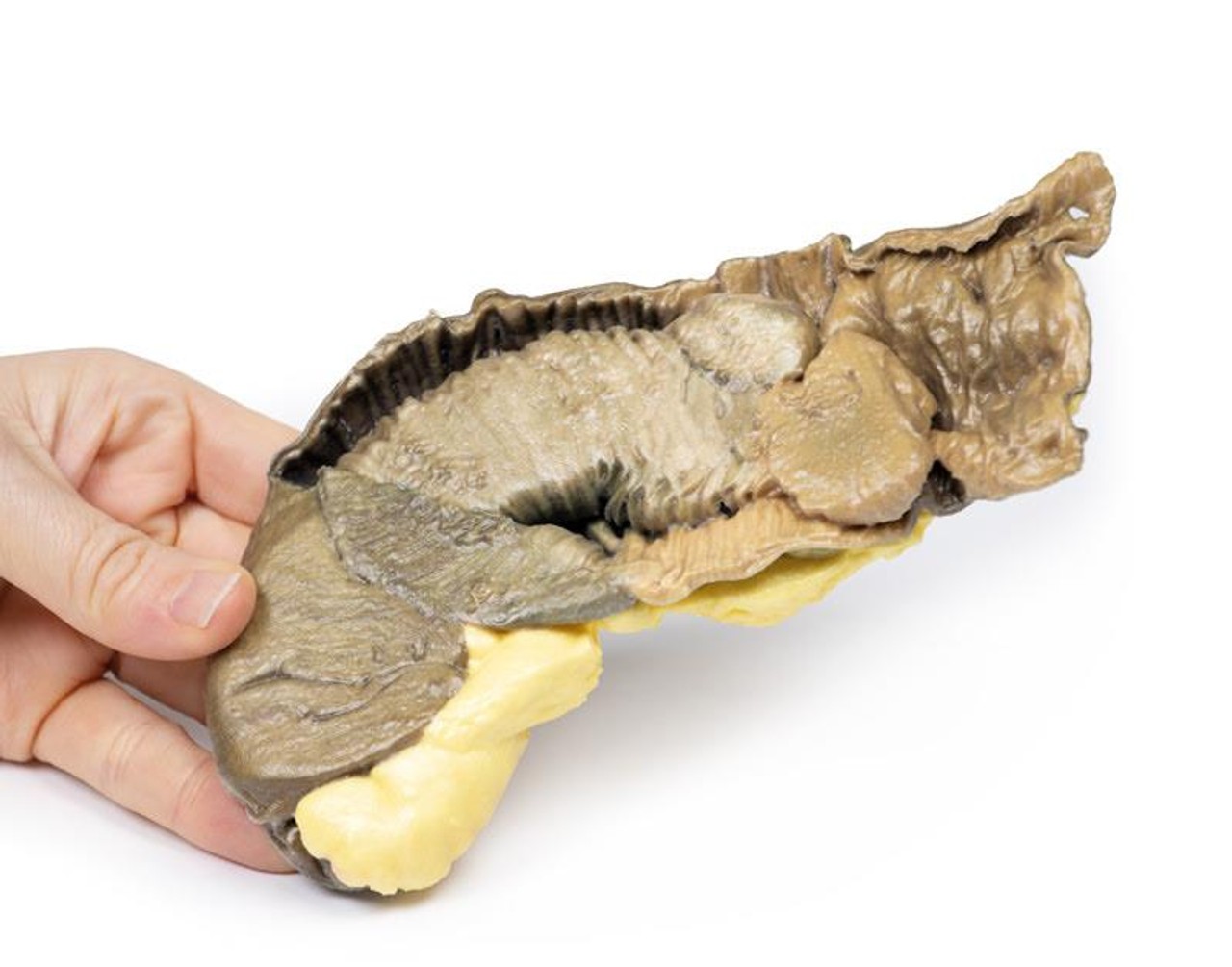 3D Printed Intussusception of Small Bowel Due to Metastatic Tumour