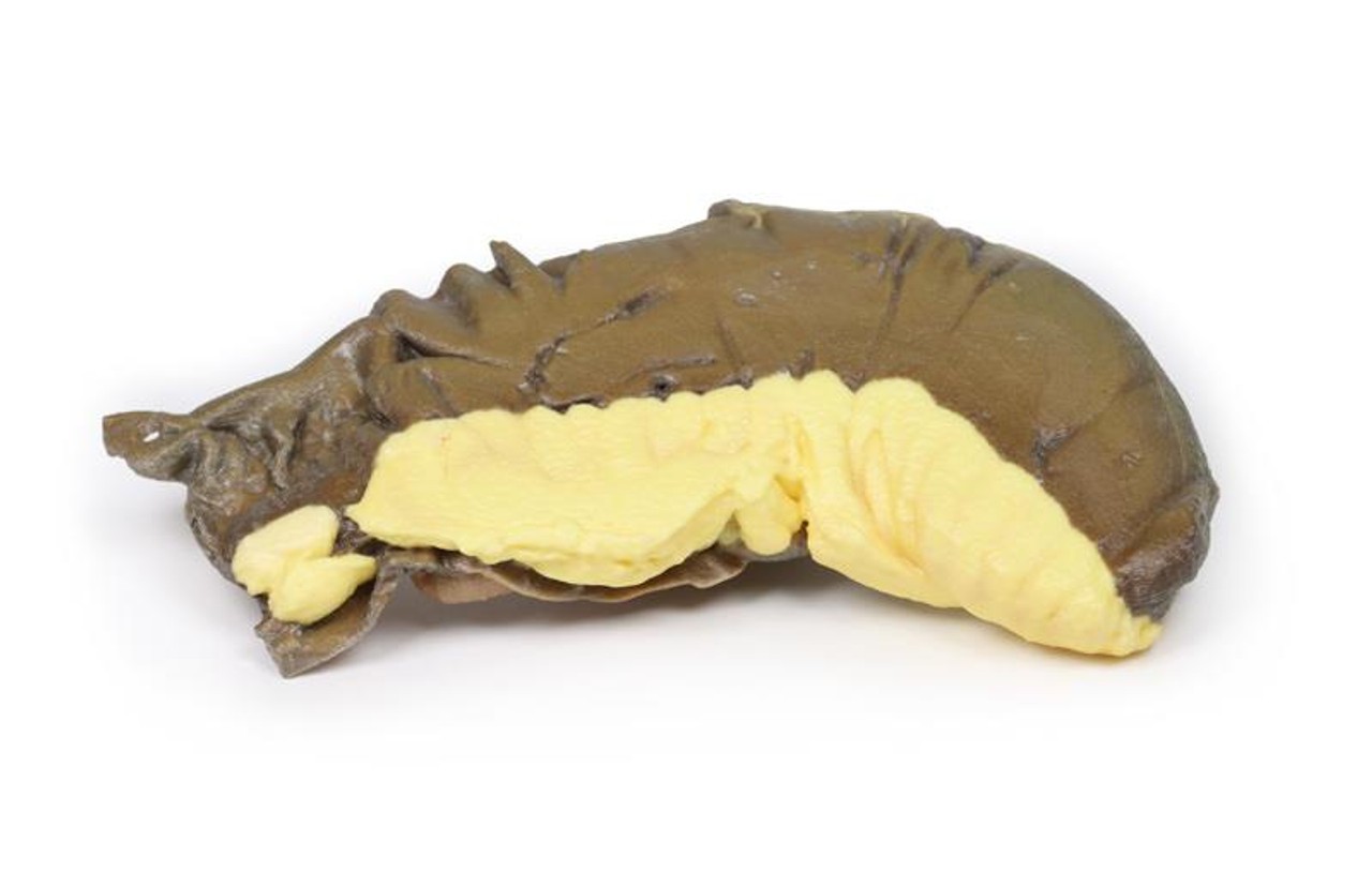 3D Printed Intussusception of Small Bowel Due to Metastatic Tumour