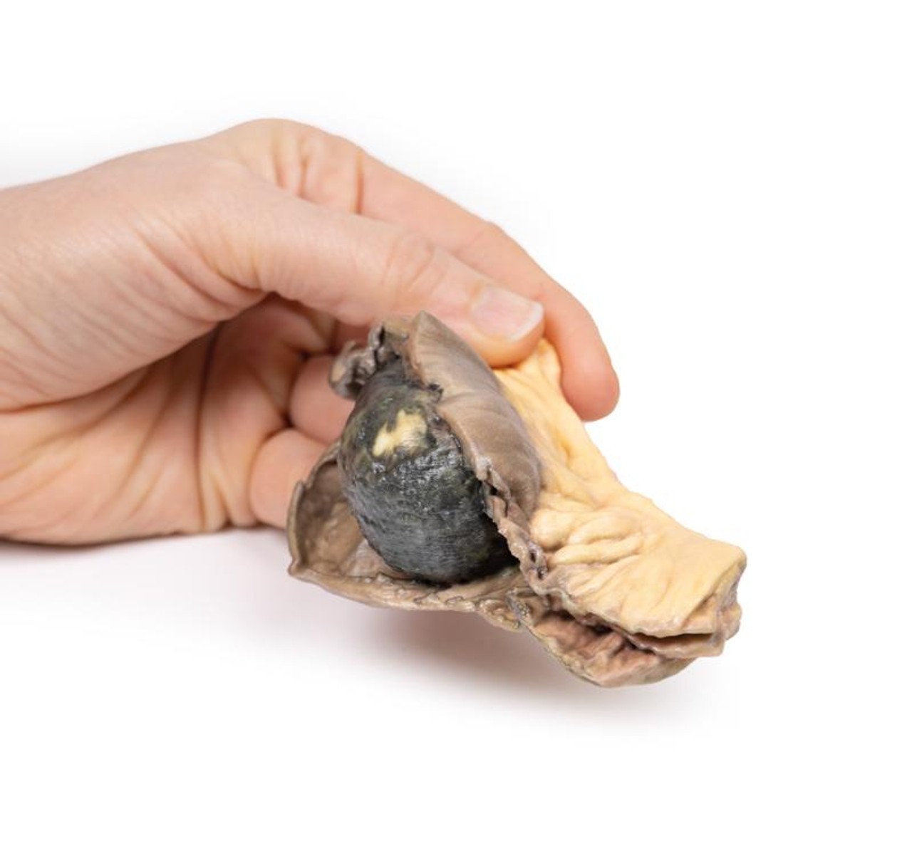 3D Printed Gall Stone Ileus
