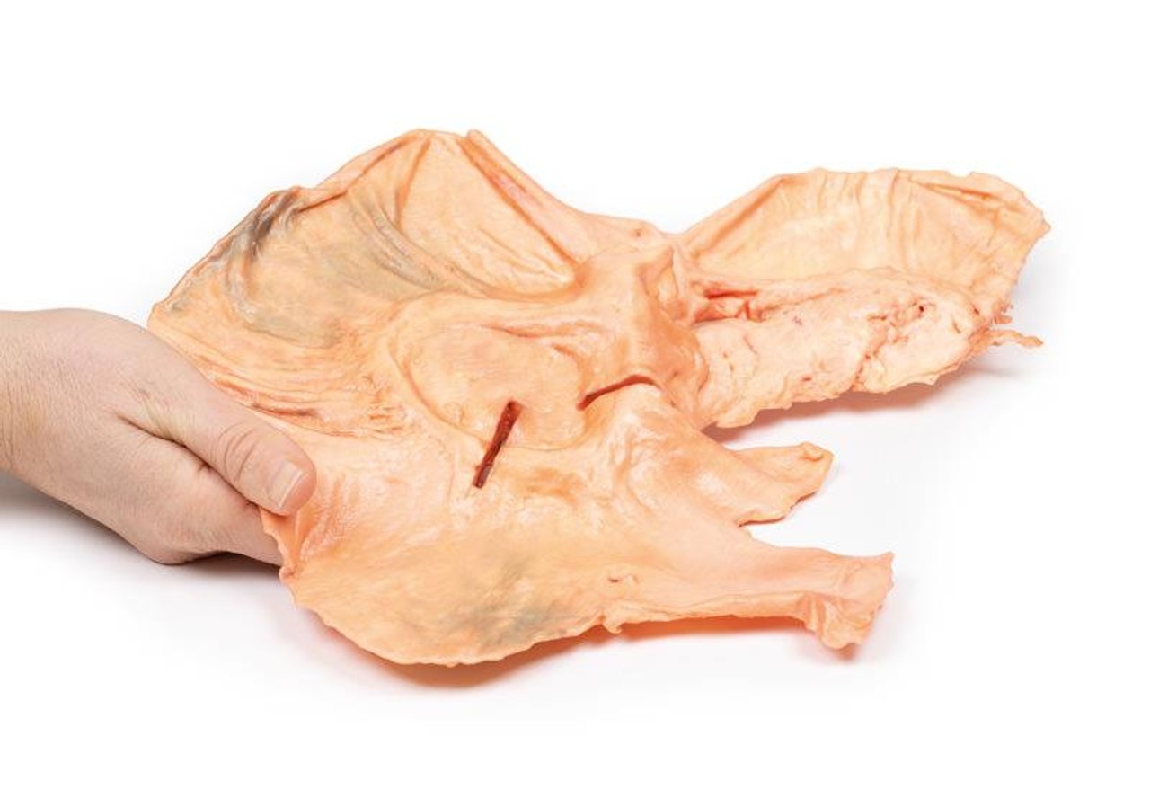 3D Printed Adenocarcinoma of the Stomach
