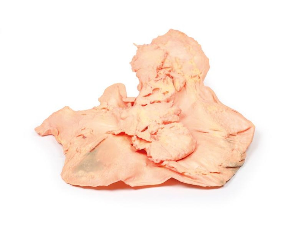 3D Printed Adenocarcinoma of the Stomach