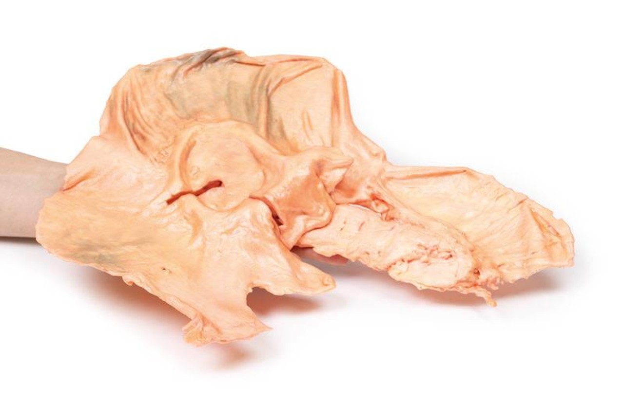 3D Printed Adenocarcinoma of the Stomach