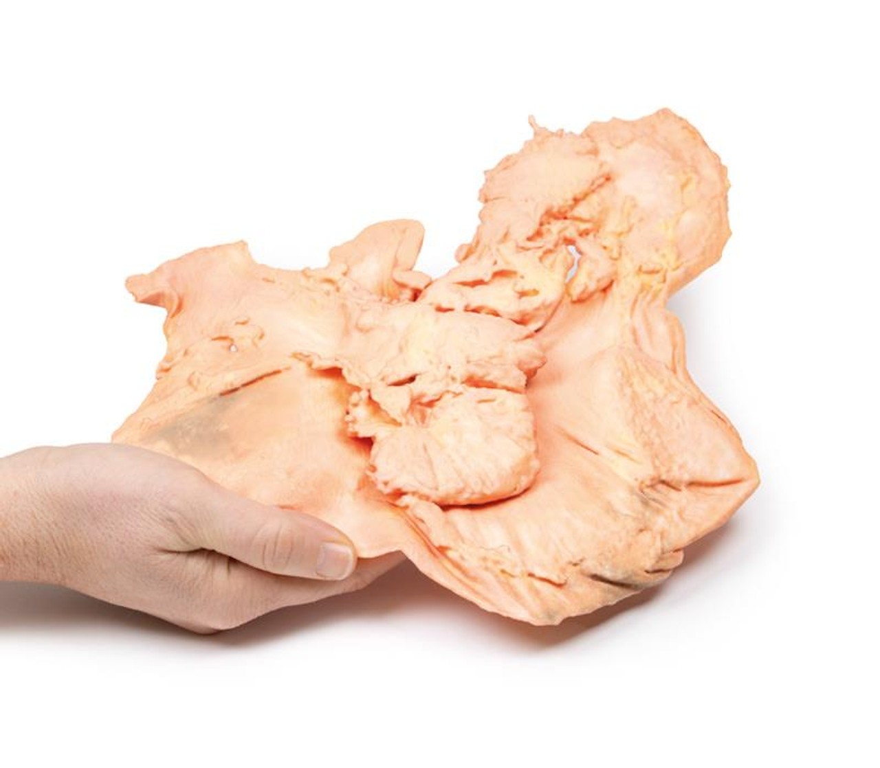 3D Printed Adenocarcinoma of the Stomach
