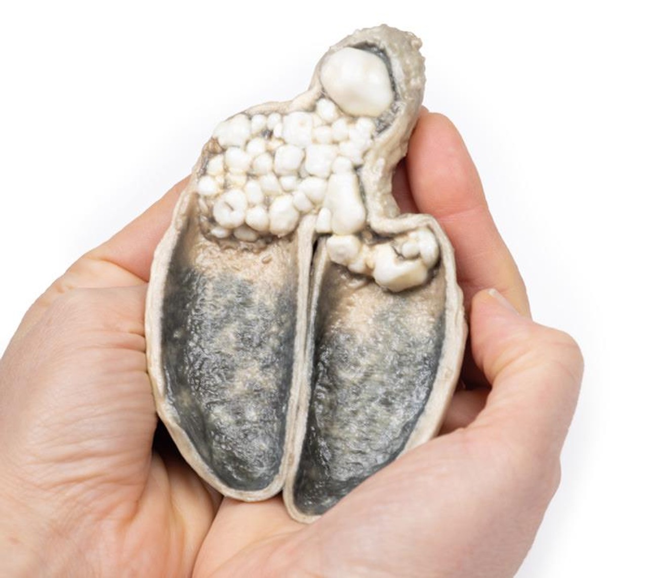 3D Printed Cholecystitis and Cholelithiasis