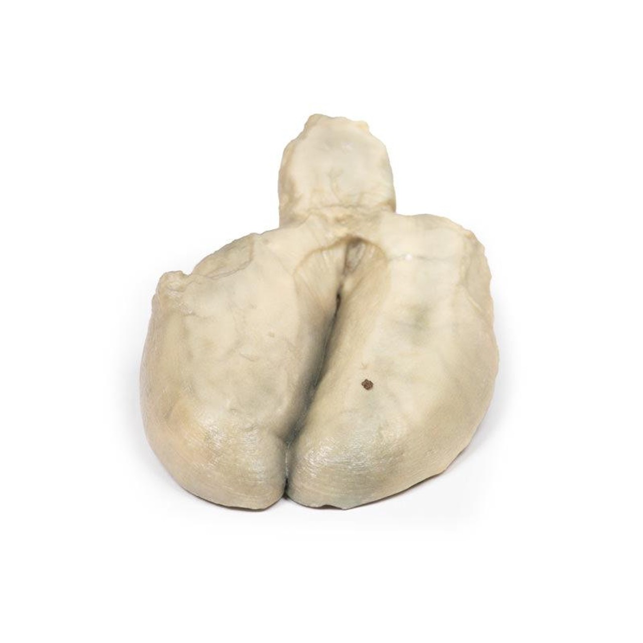 3D Printed Cholecystitis and Cholelithiasis