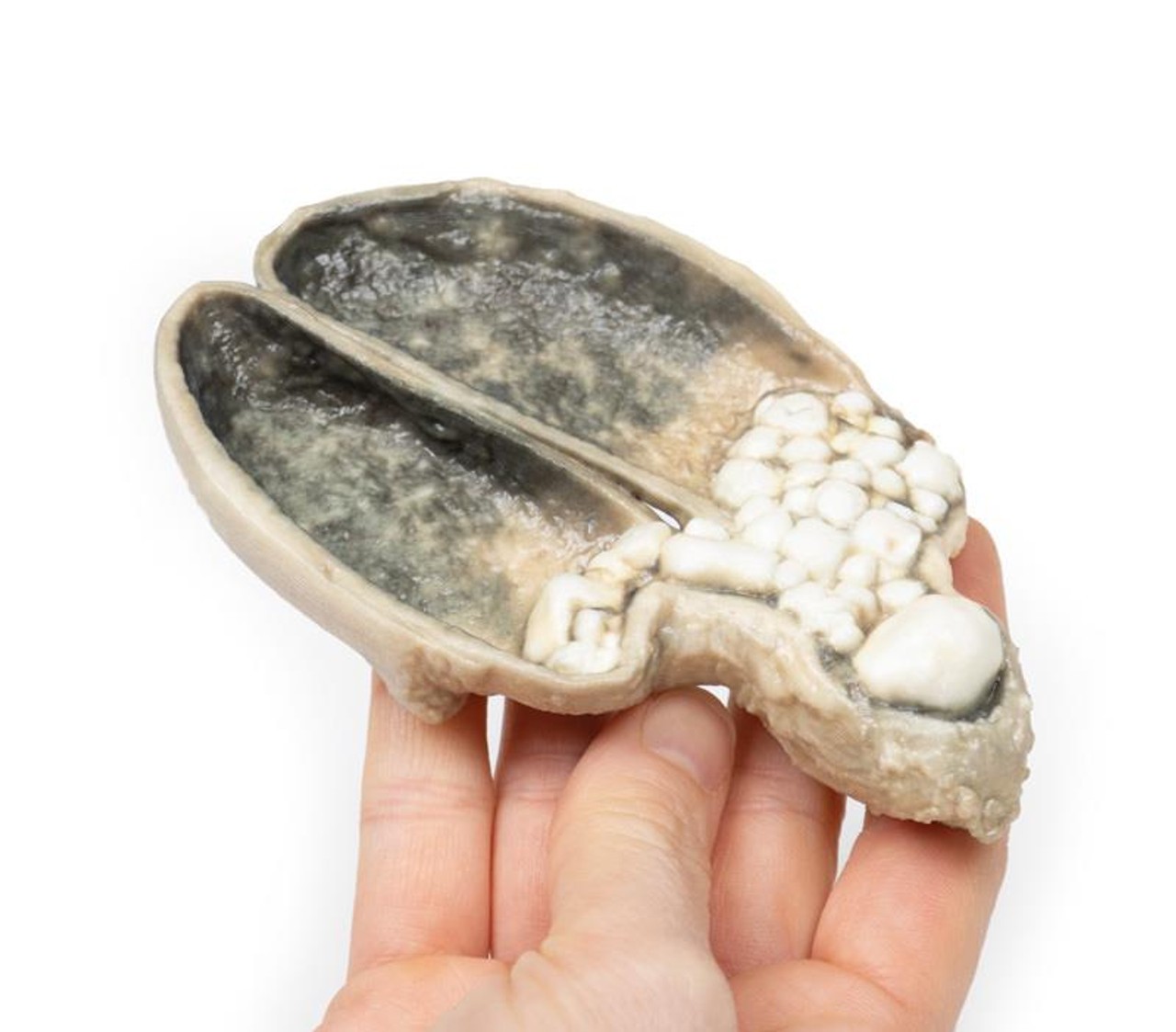 3D Printed Cholecystitis and Cholelithiasis