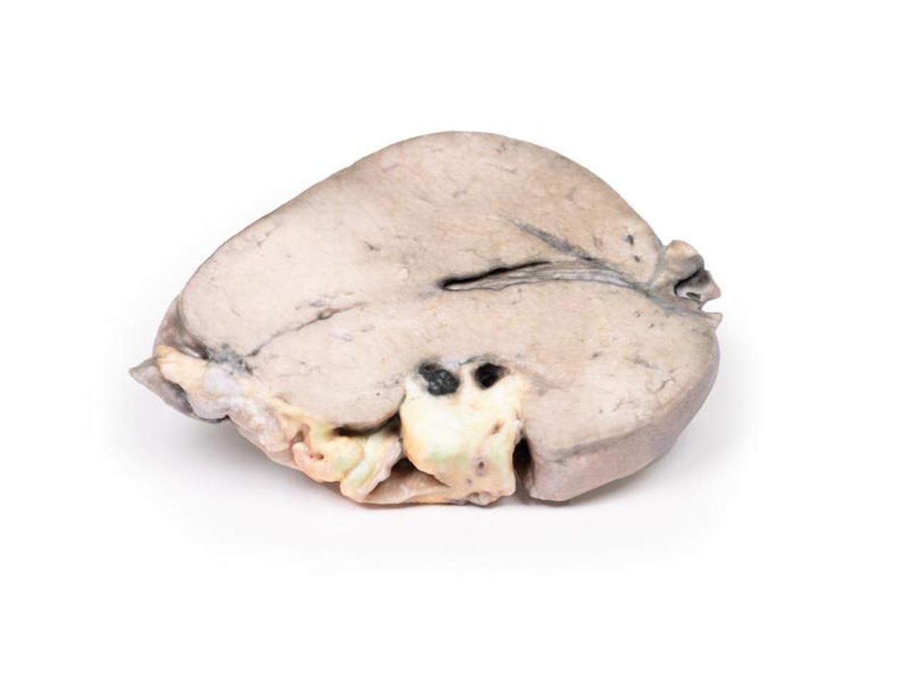 3D Printed Hepatic Duct Calculi and Obstructive Biliary Cirrhosis