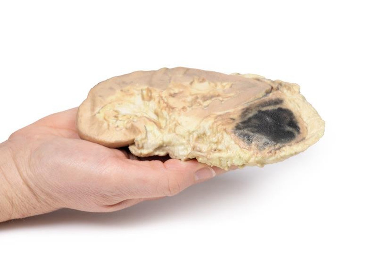 3D Printed Adrenal Haemorrhage with Waterhouse-Friderichsen Syndrome