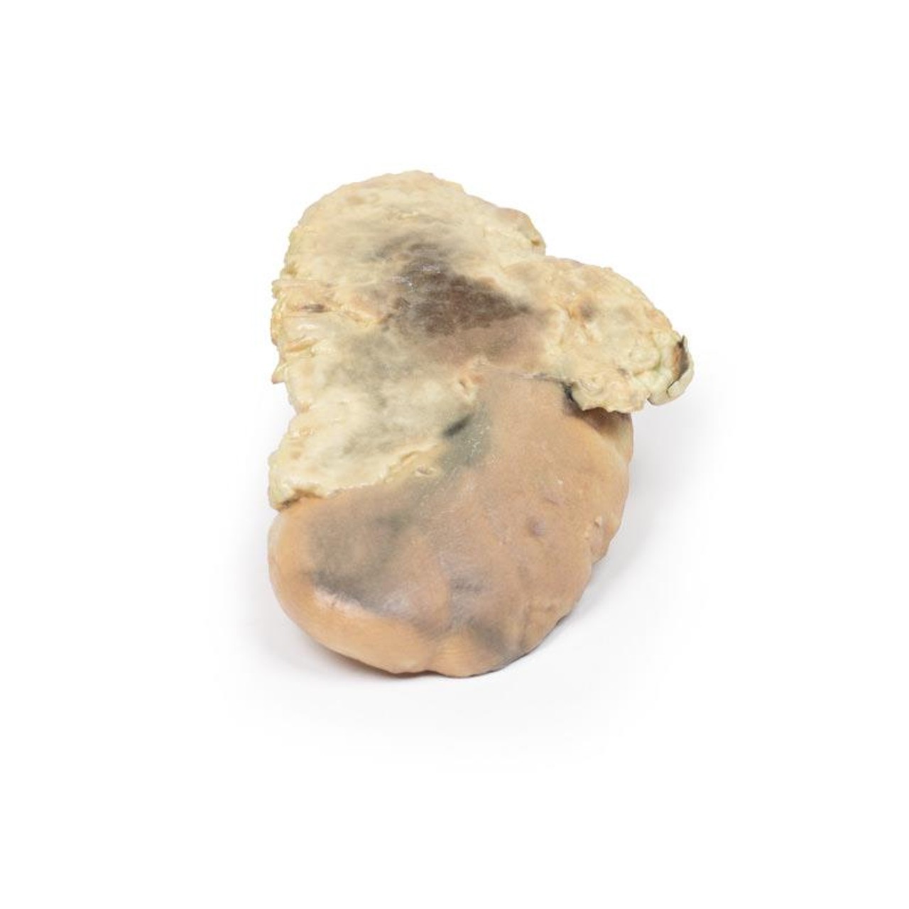 3D Printed Adrenal Haemorrhage with Waterhouse-Friderichsen Syndrome