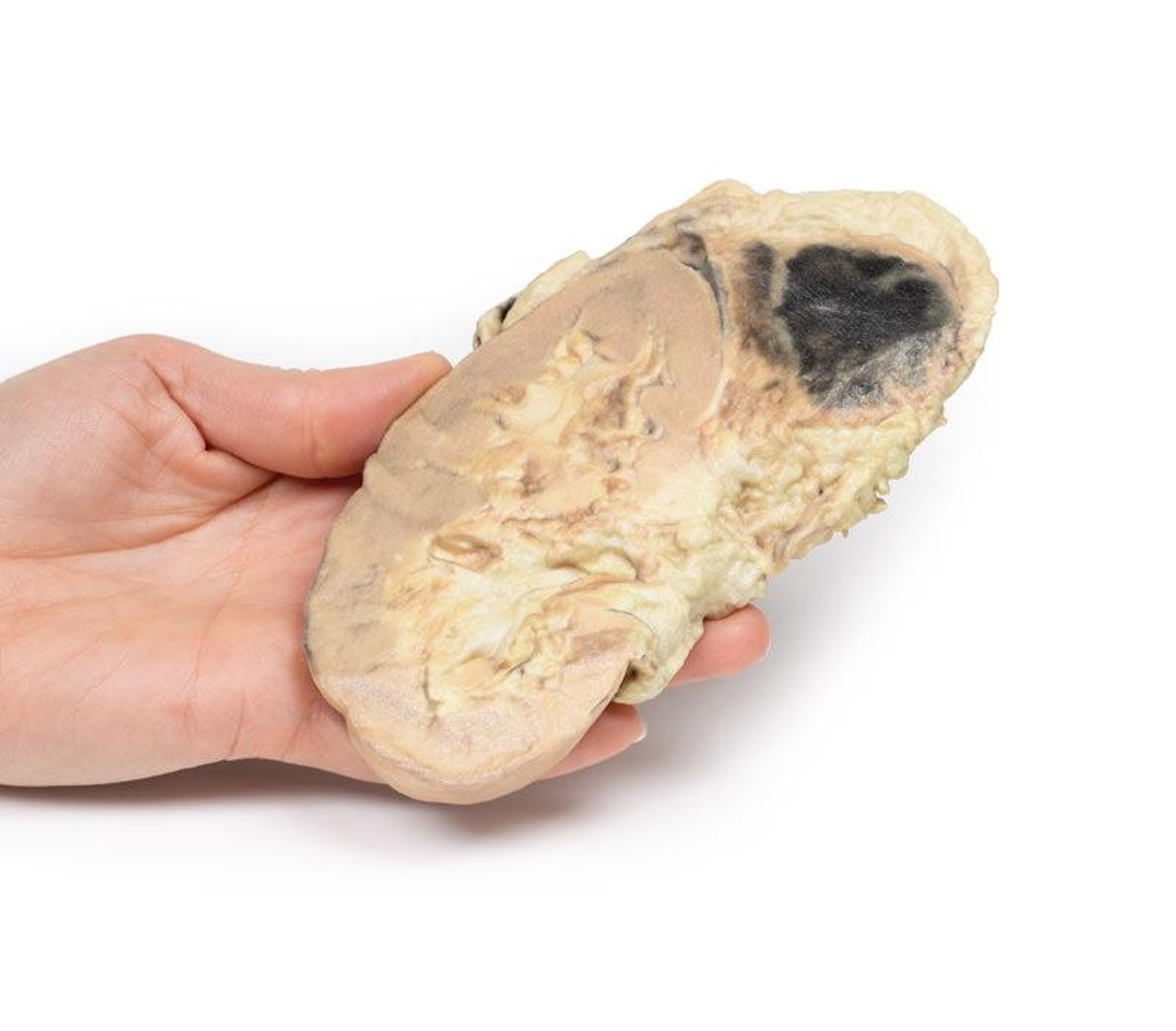 3D Printed Adrenal Haemorrhage with Waterhouse-Friderichsen Syndrome