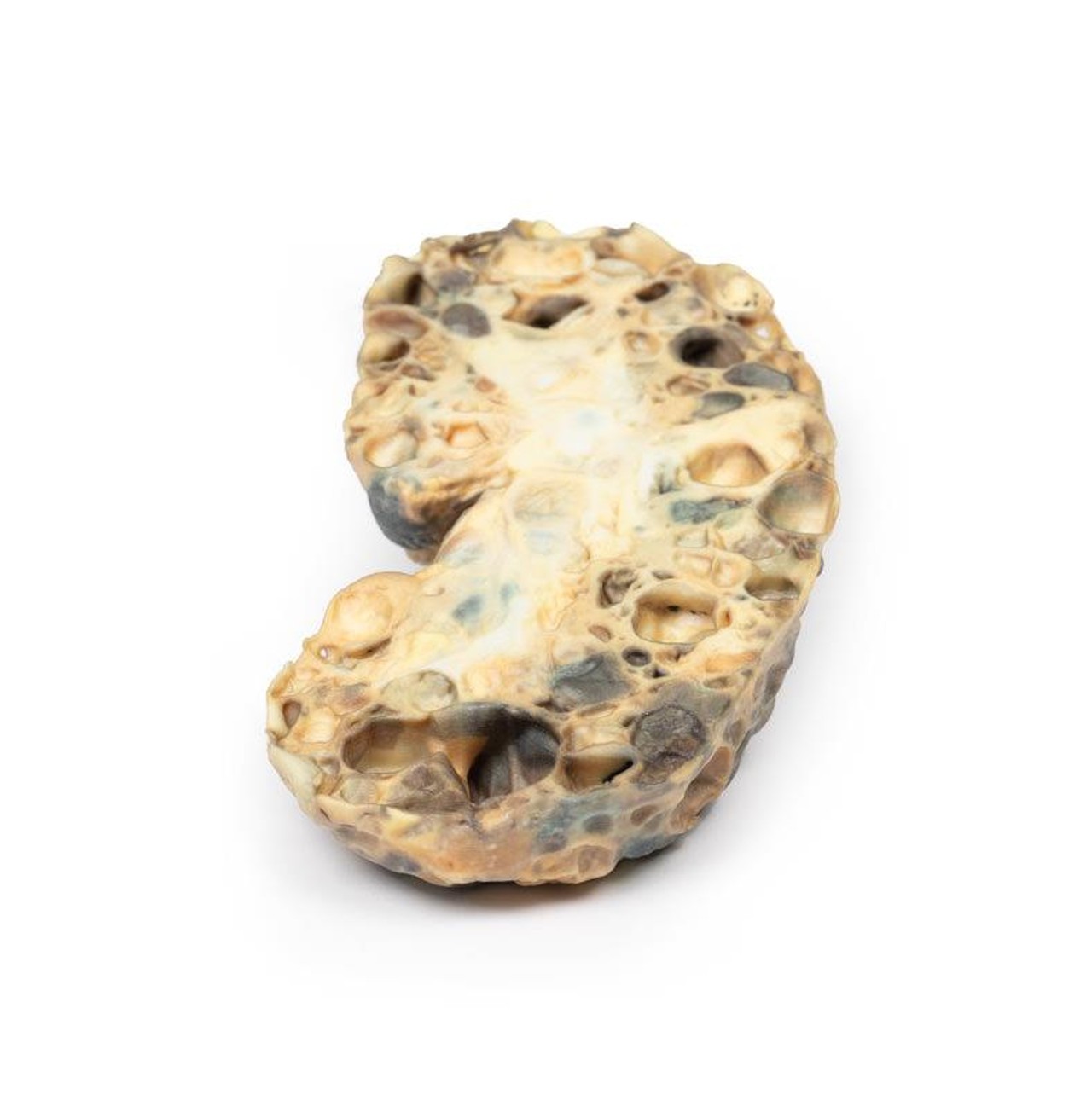 3D Printed Adult Polycystic Kidney Disease